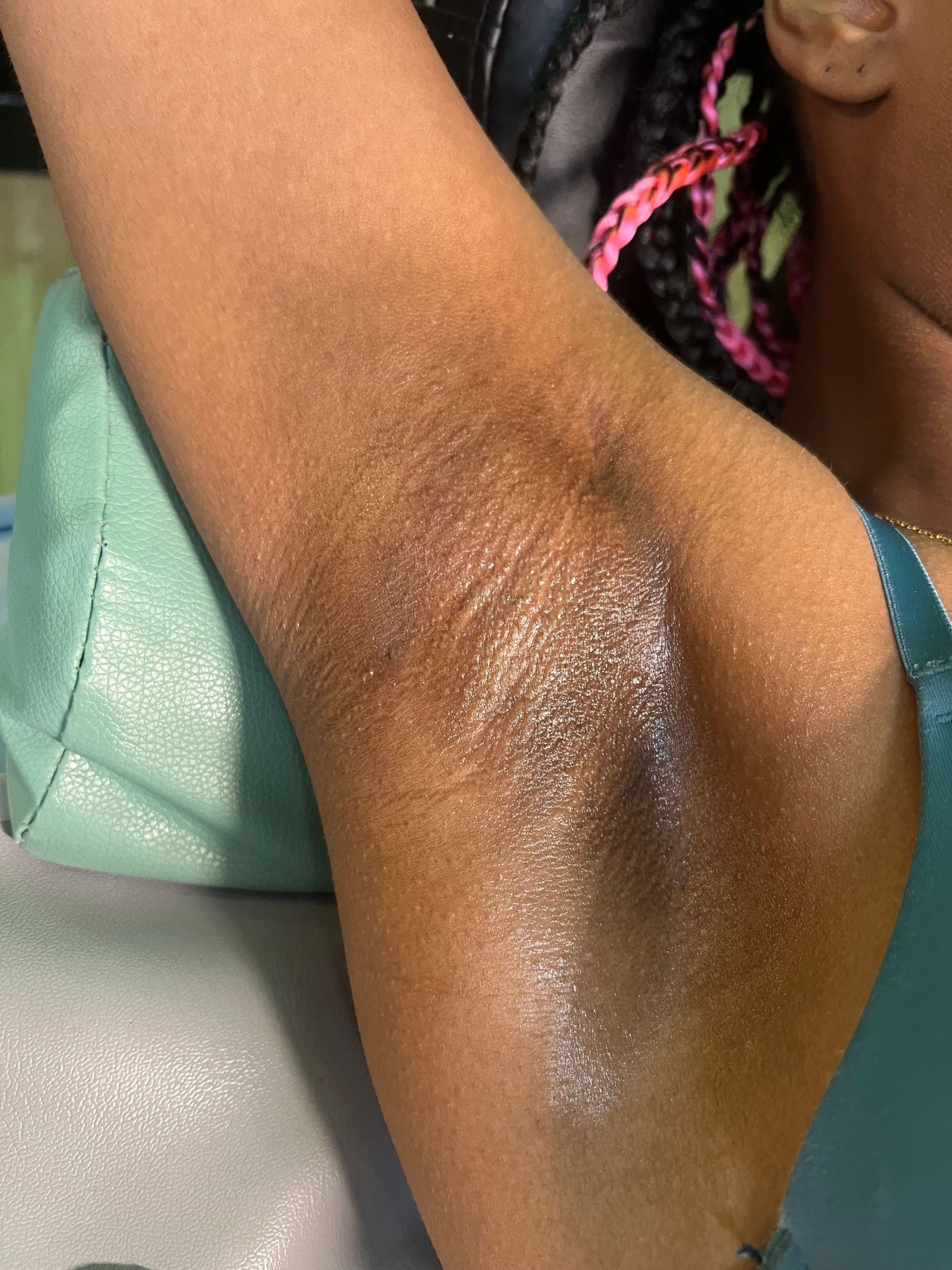 Underarm after sugaring