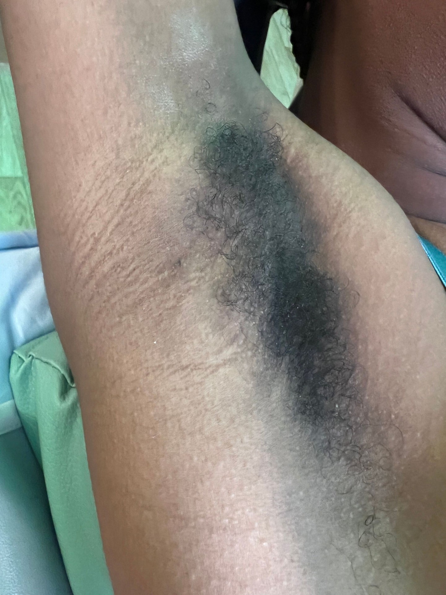 Underarm before sugaring